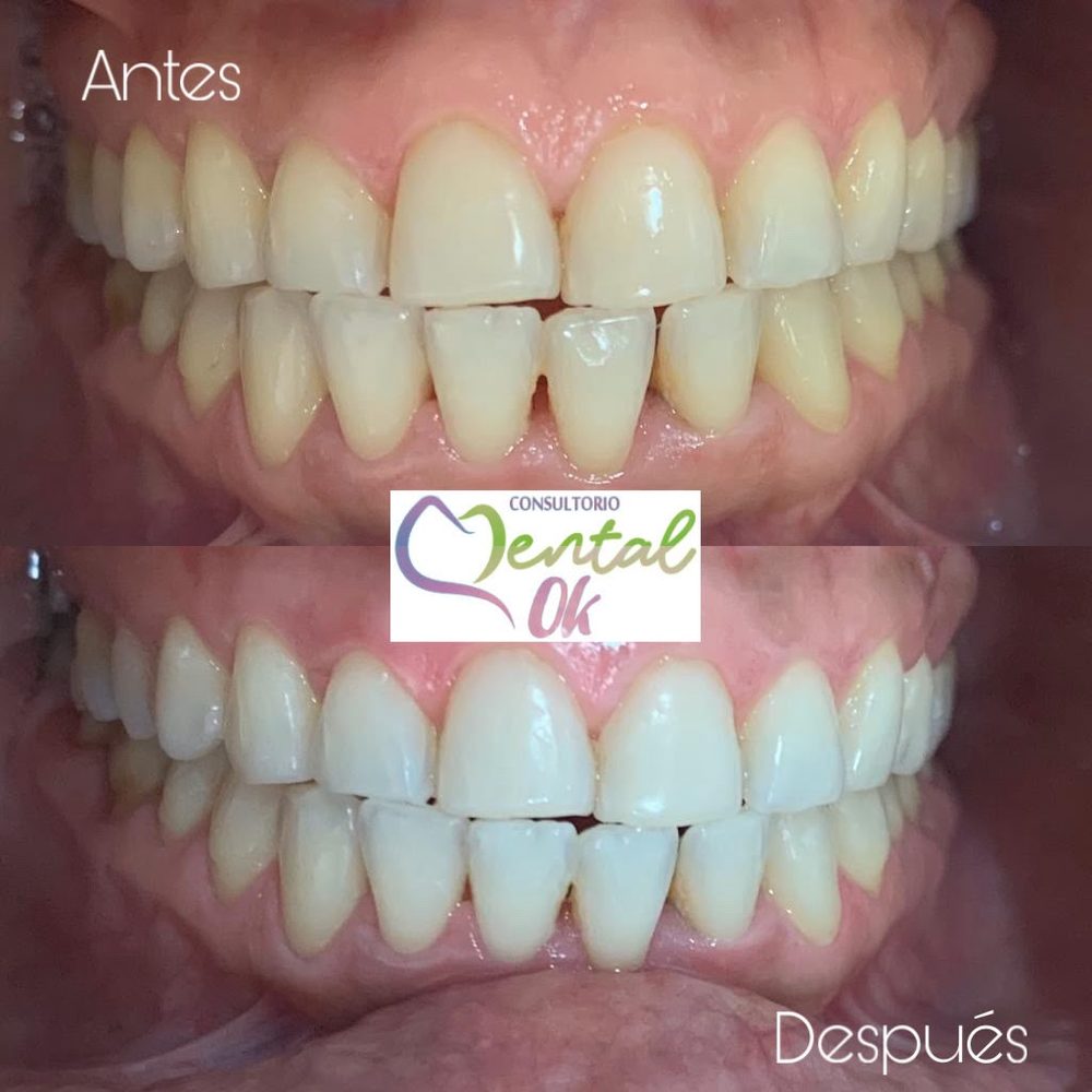 Antes y después de un blanqueamiento dental, dientes superiores e inferiores de frente
