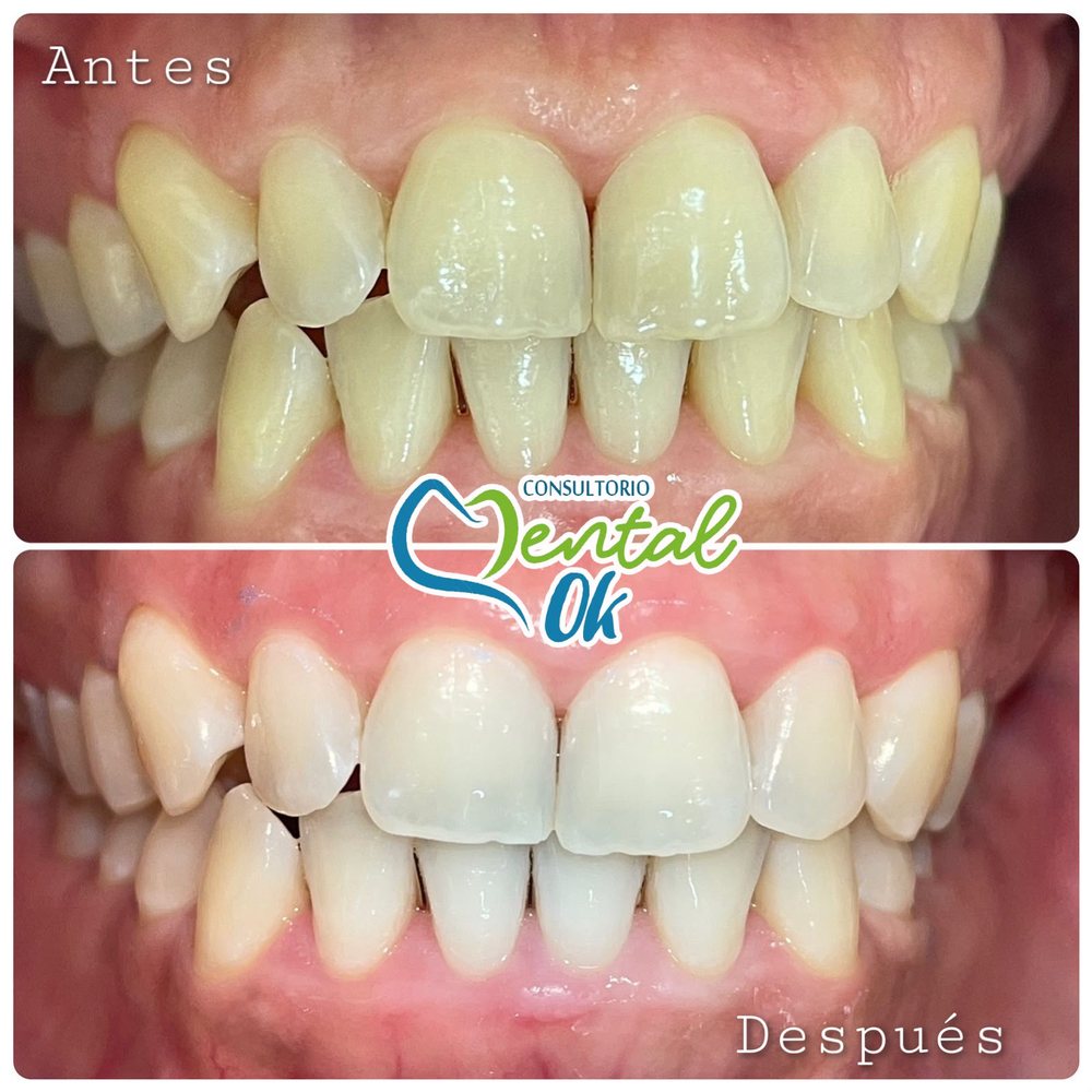 Antes y después de un blanqueamiento dental: dientes amarillentos y luego más claros