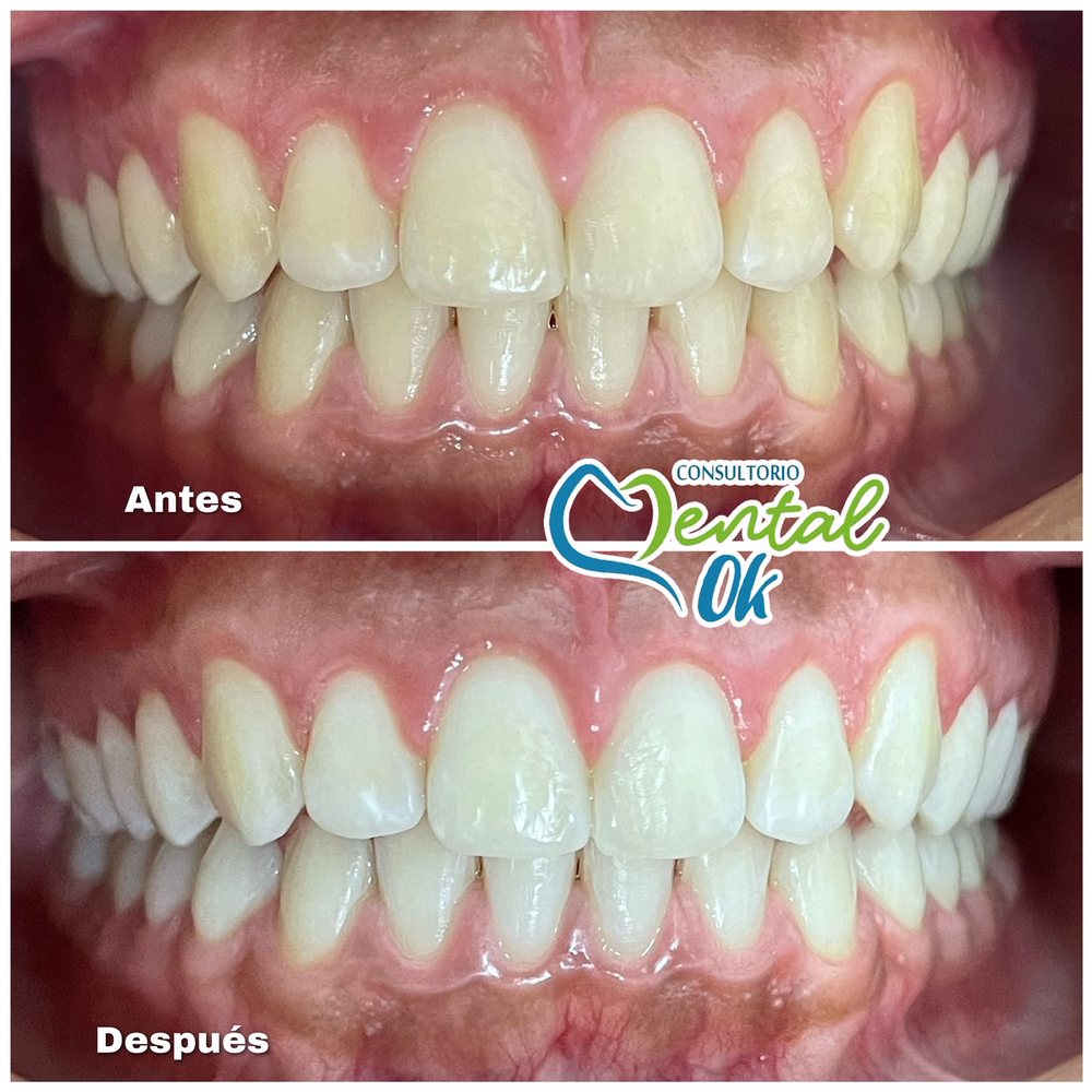 Antes y después de un blanqueamiento dental, dientes de frente con la boca cerrada