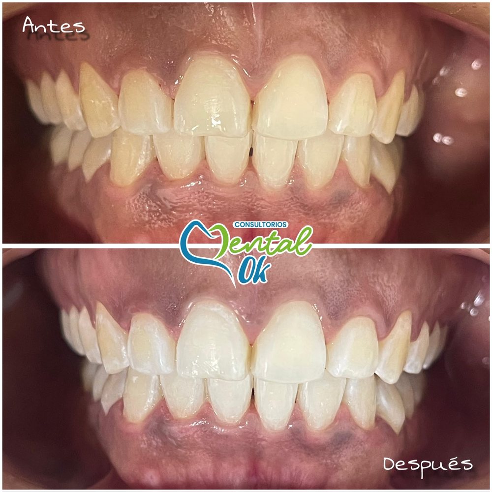 Antes y después de un blanqueamiento dental, dientes de frente con la boca cerrada