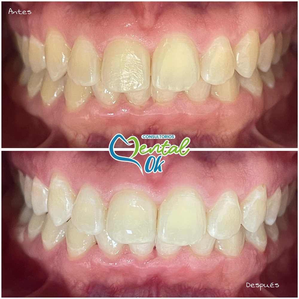 Antes y después de un blanqueamiento dental, dientes superiores e inferiores de frente