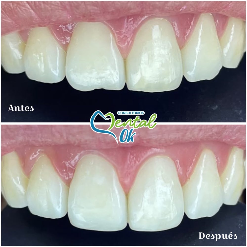 Antes y después de la reconstrucción de bordes en los dos dientes delanteros