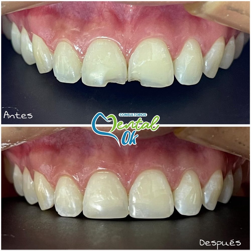Antes y después de bordes estéticos en dos dientes delanteros fracturados