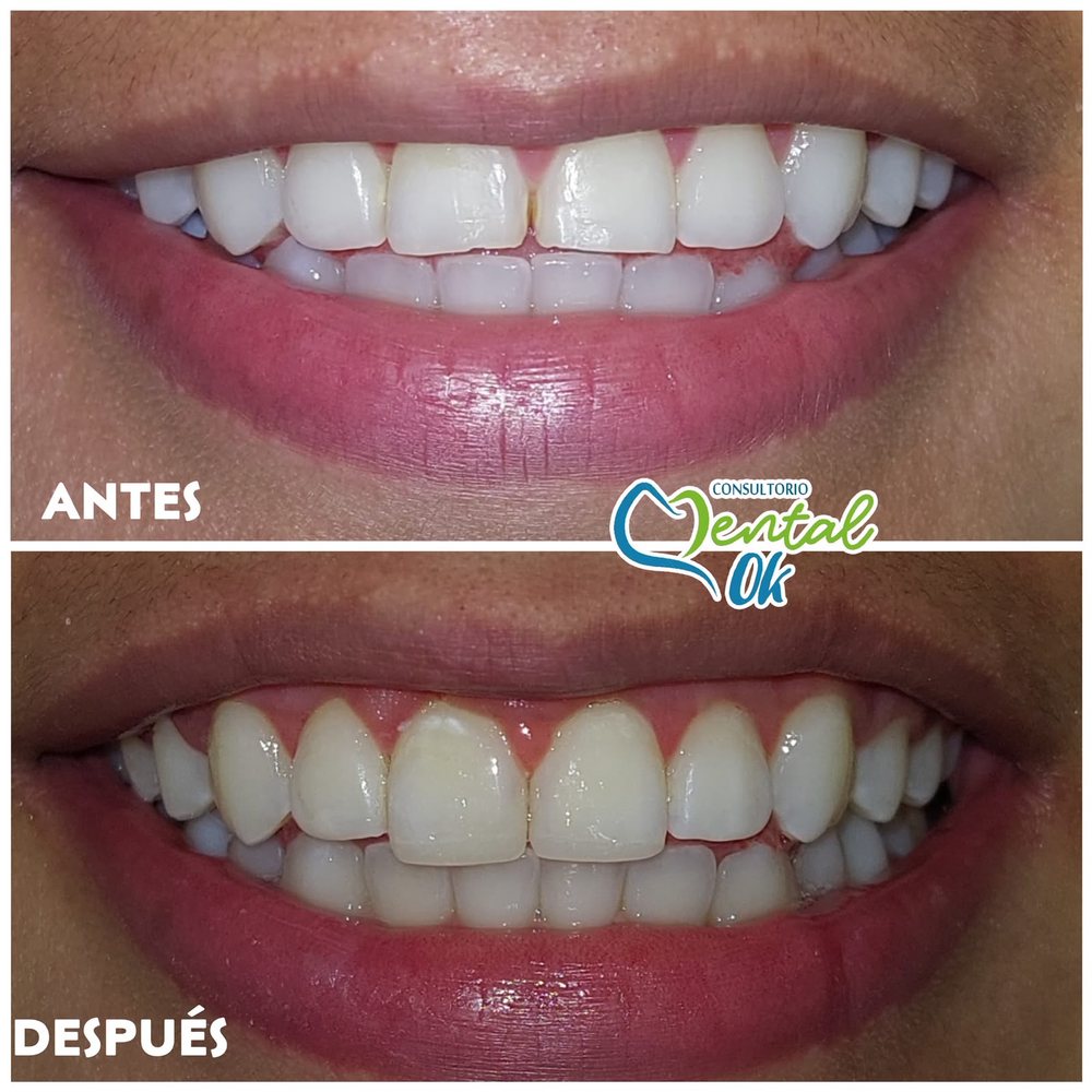 Antes y después de bordes estéticos en los dientes delanteros superiores