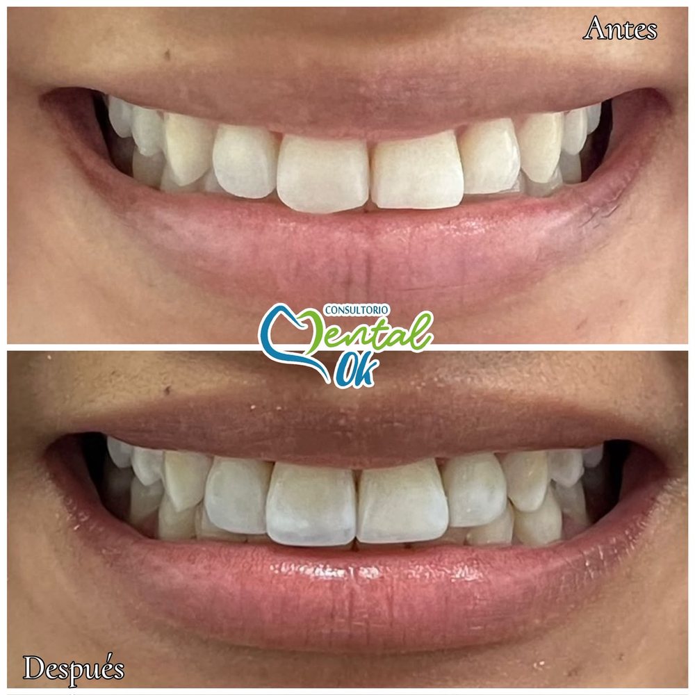 Antes y después de bordes estéticos en los dientes delanteros superiores, sonrisa de frente