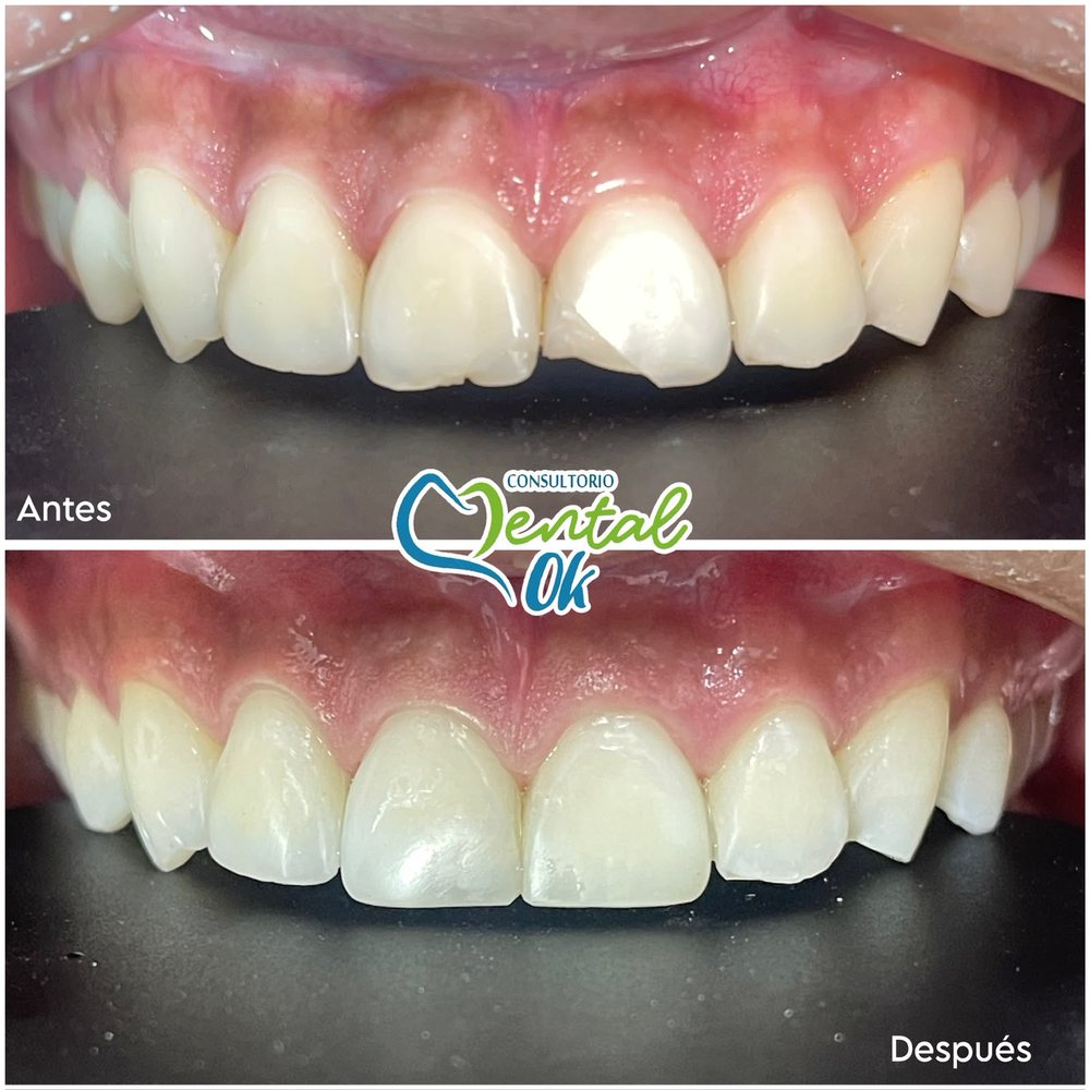 Antes y después de bordes estéticos en los dientes delanteros superiores desgastados
