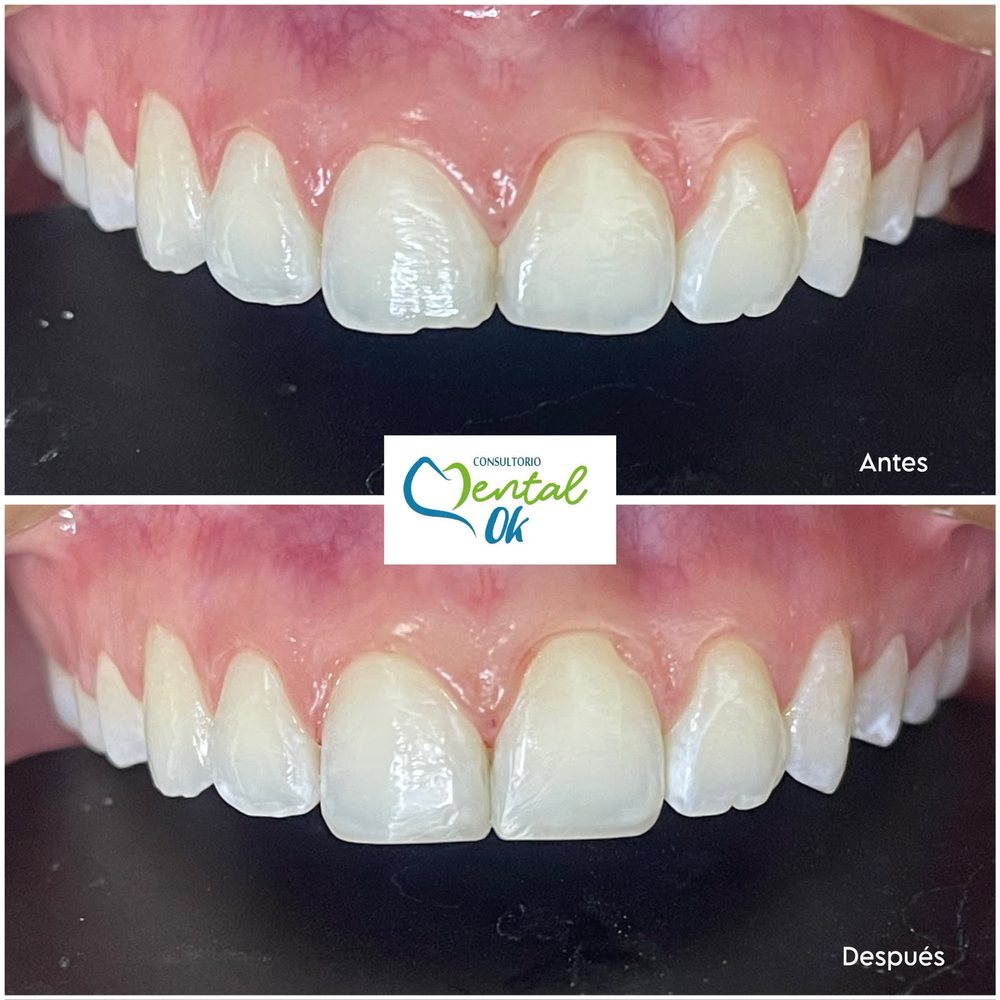Antes y después de bordes estéticos en los dientes delanteros superiores