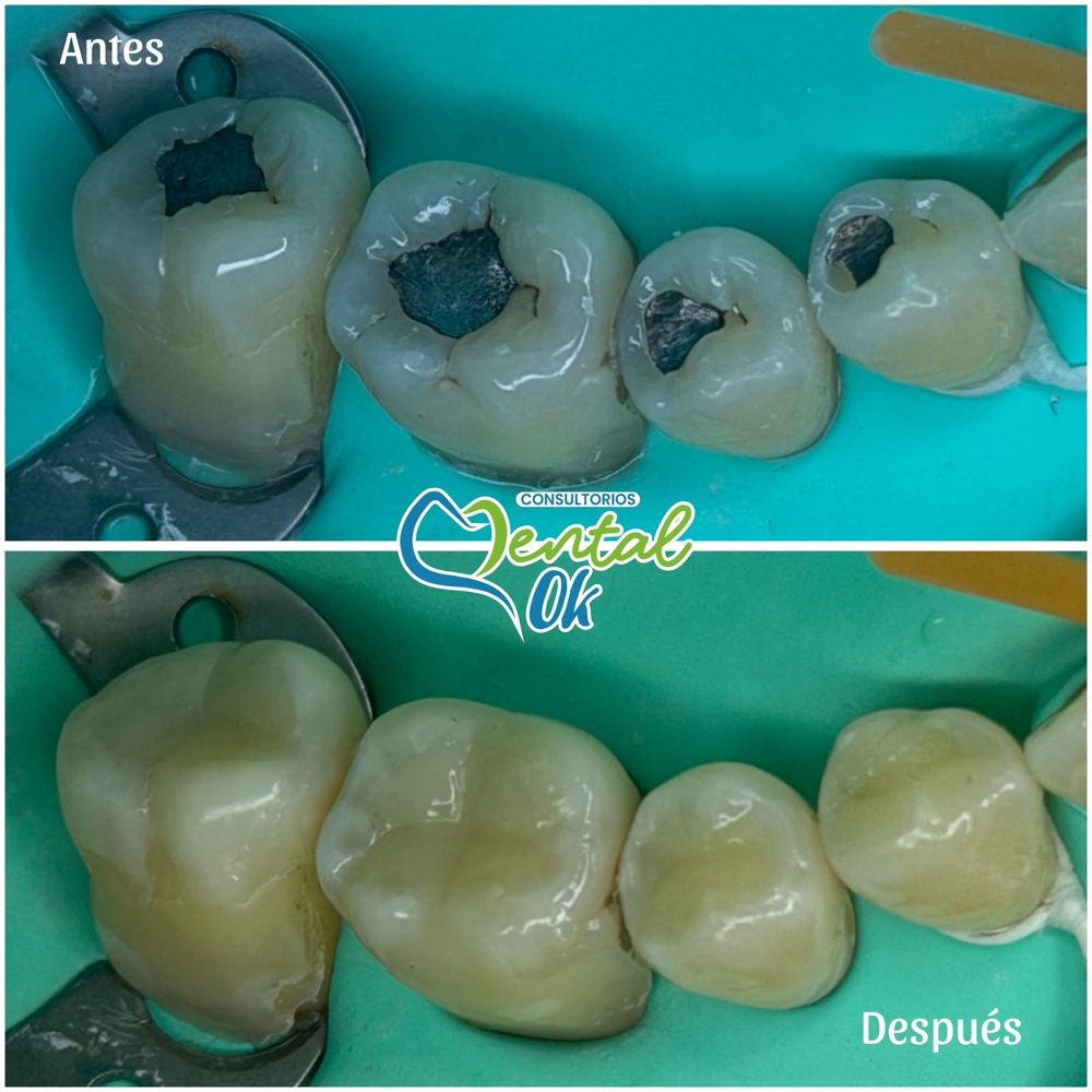 Antes y después del cambio de amalgama por resina en cuatro muelas, caso atendido en Dental OK