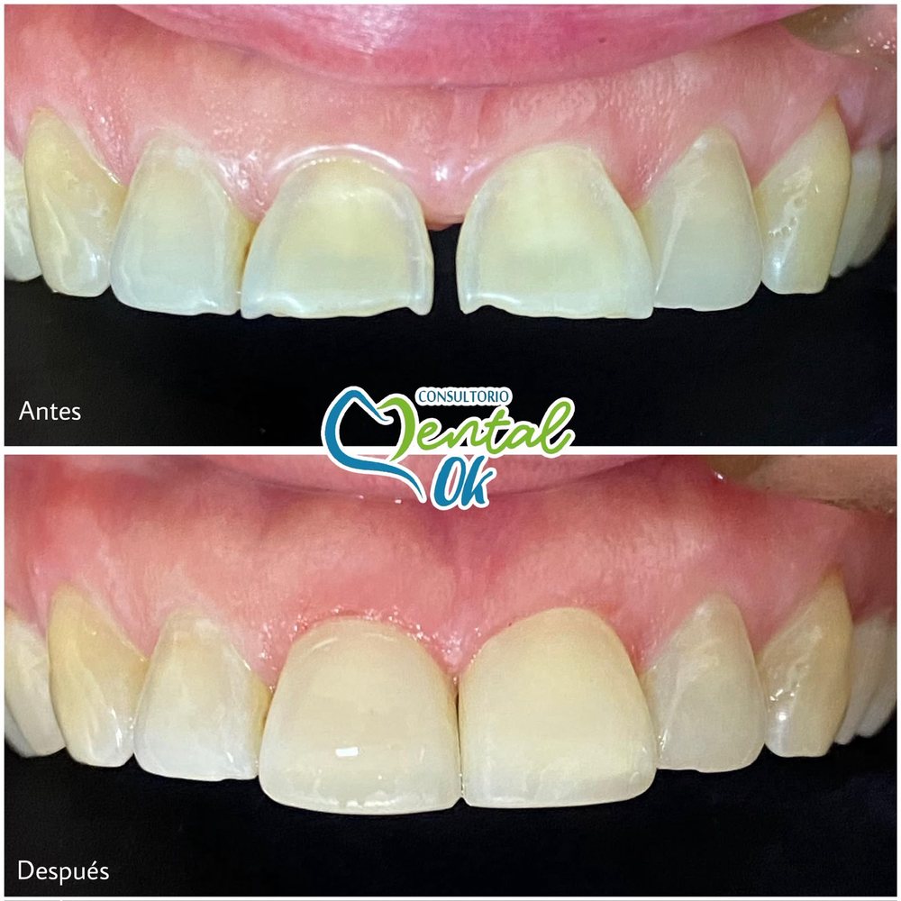 Antes y después de carillas en los dientes delanteros superiores desgastados