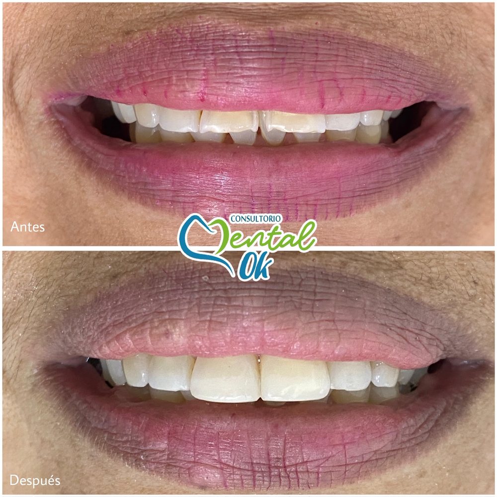 Antes y después de carillas en los dientes delanteros superiores, vista de la sonrisa