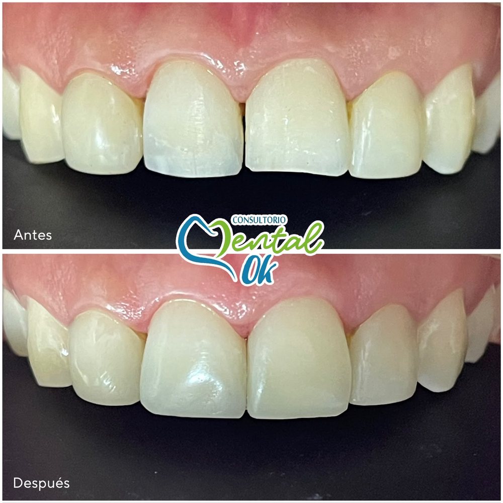Antes y después de carillas de resina en los dientes delanteros superiores