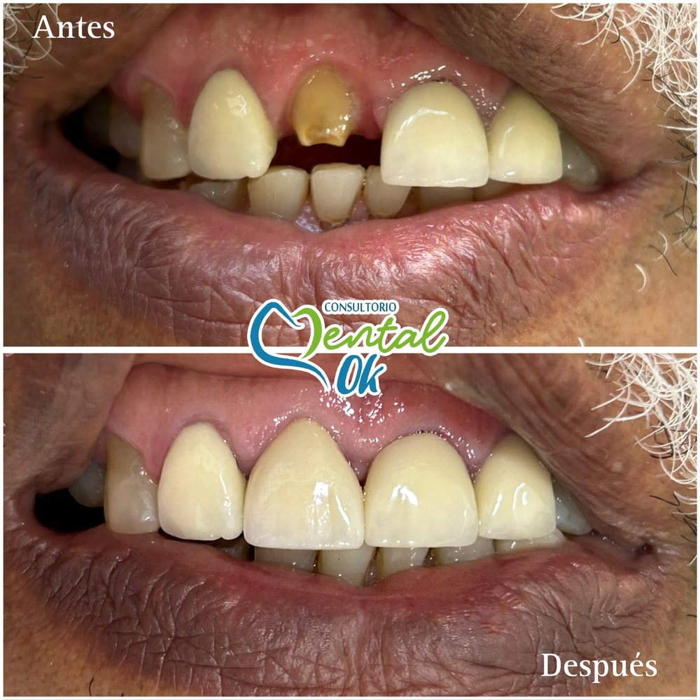 Antes y después de una corona en un diente delantero superior muy dañado