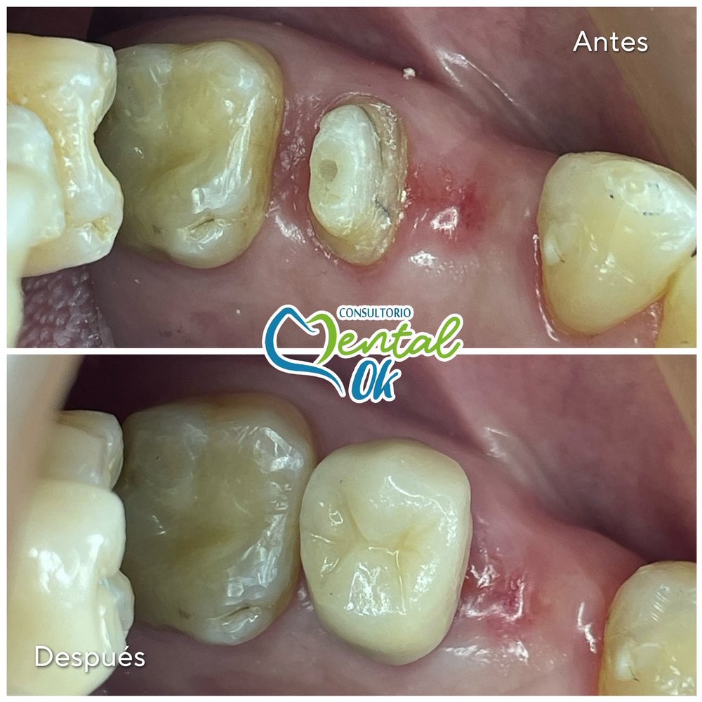 Antes y después de una corona en una muela: diente preparado y luego con la corona colocada