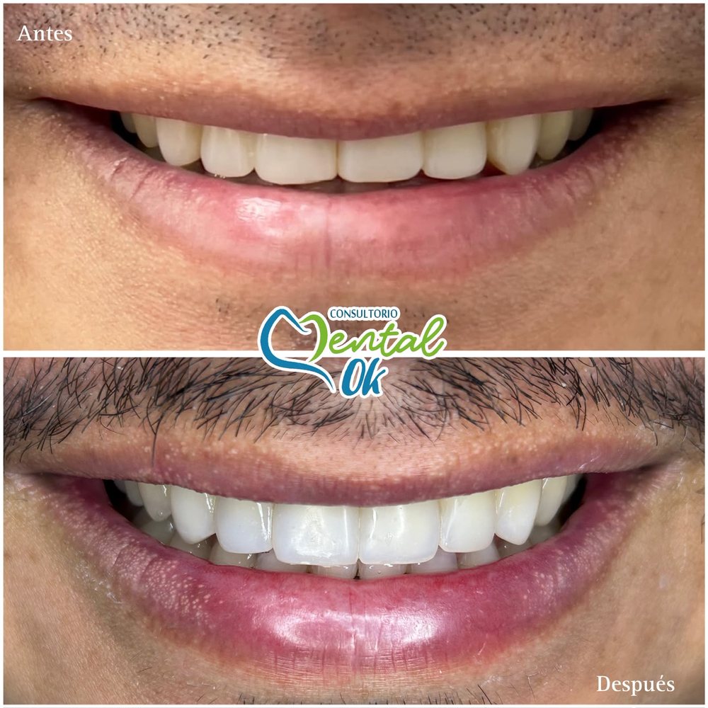 Antes y después de un diseño de sonrisa con carillas de resina en los dientes superiores