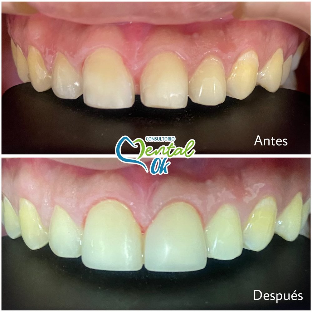 Antes y después de un diseño de sonrisa en los dientes delanteros superiores