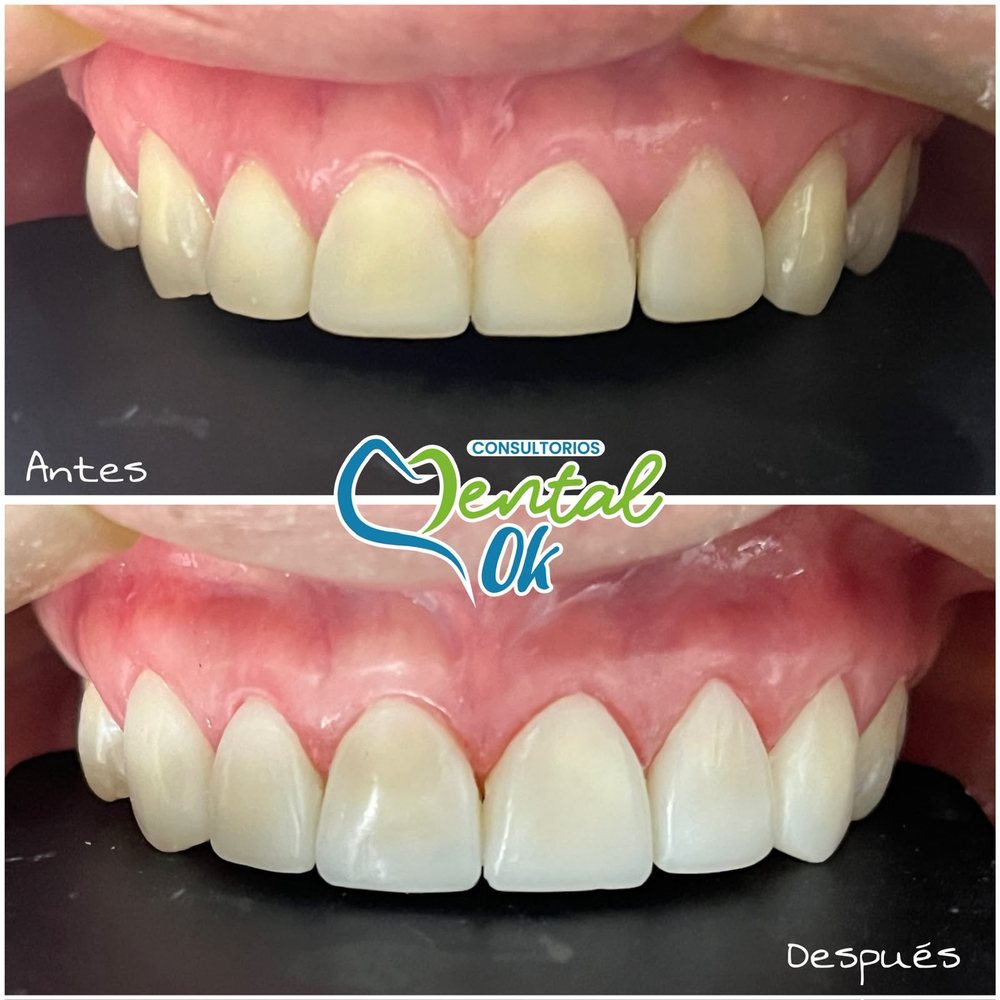 Antes y después de un diseño de sonrisa en los dientes superiores