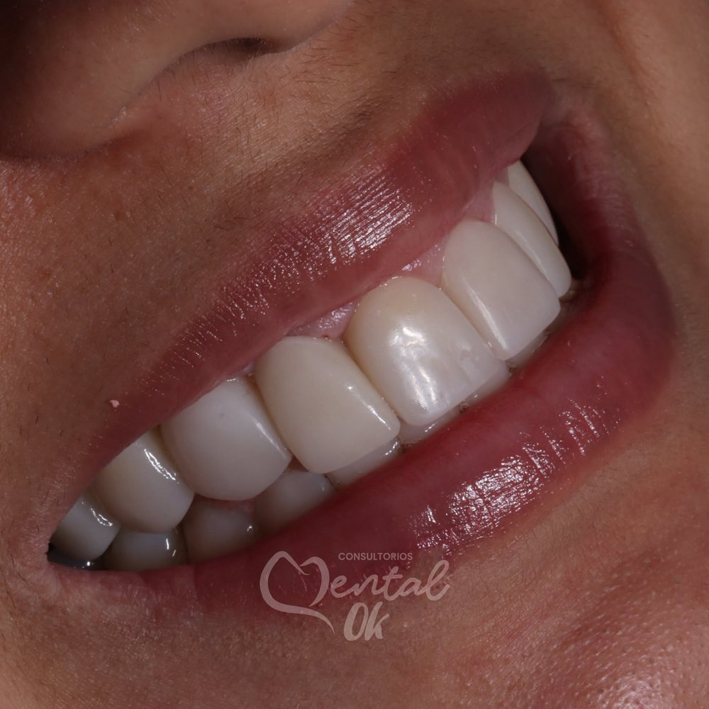 Resultado de un diseño de sonrisa, vista de cerca de los dientes superiores