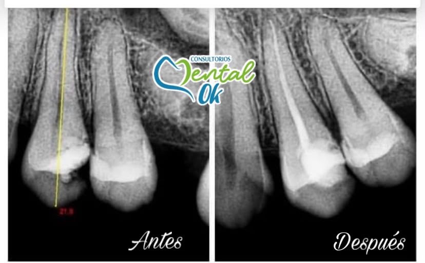Radiografía de un diente antes y después del tratamiento de conducto