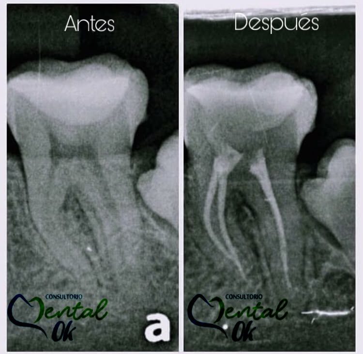 Radiografía de una muela antes y después del tratamiento de conducto