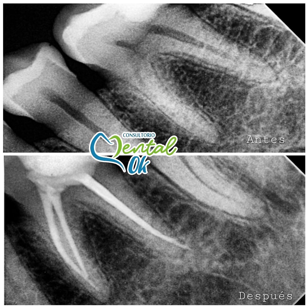 Radiografía de una muela antes y después del tratamiento de conducto, con los conductos sellados