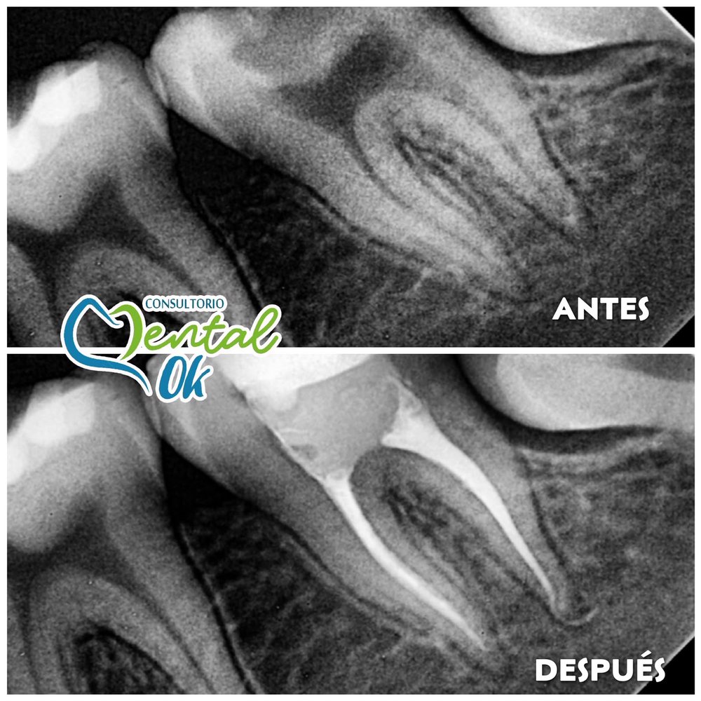 Radiografía de una muela inferior antes y después del tratamiento de conducto