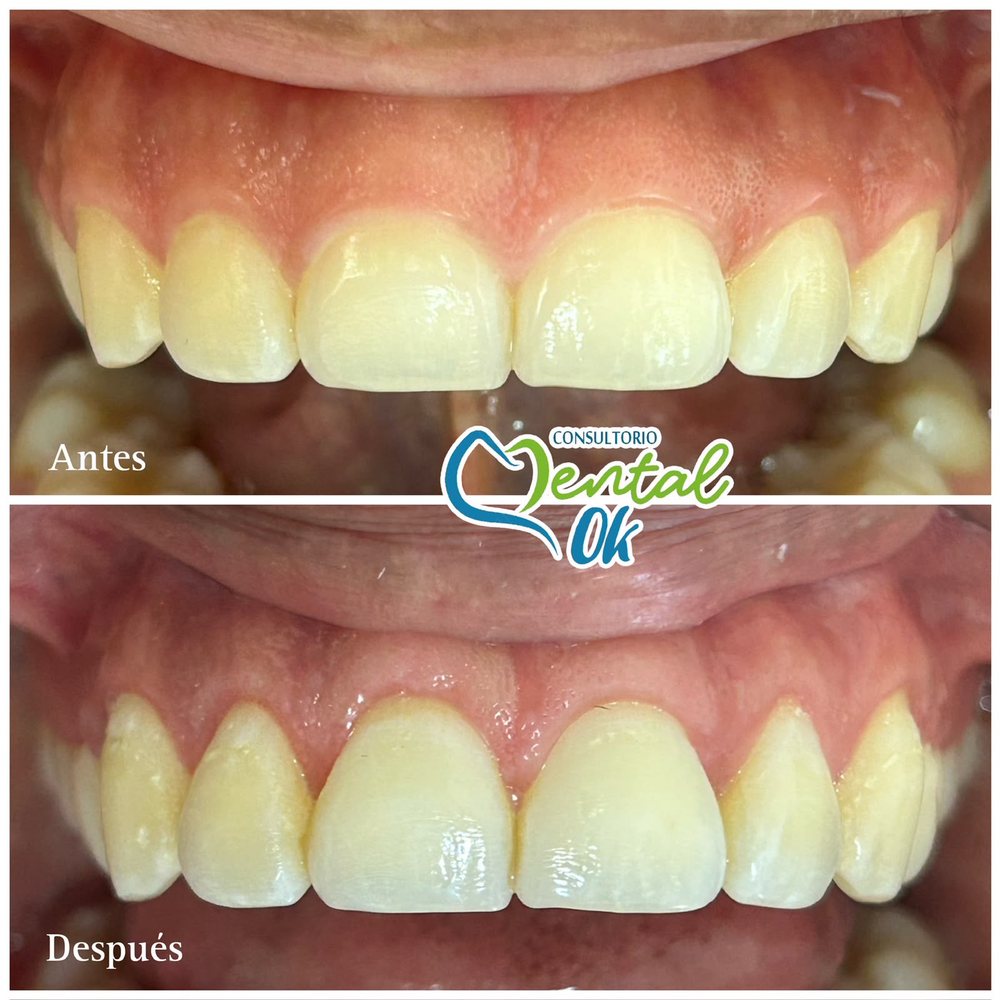 Antes y después del recorte de encía en los dientes delanteros superiores