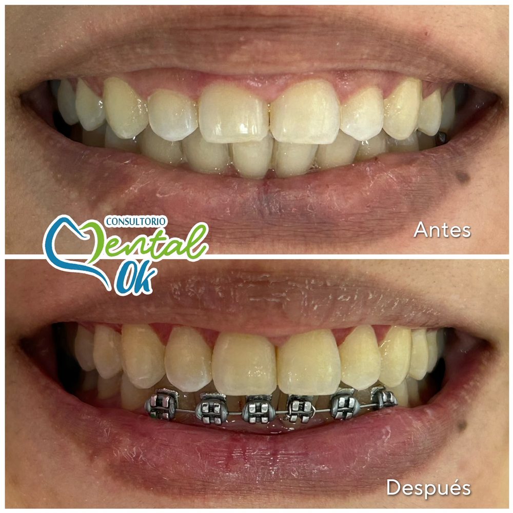 Antes y después del recorte de encía en los dientes superiores de un paciente con brackets