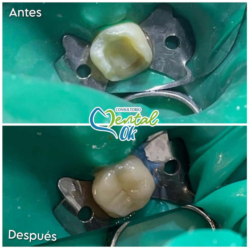 Antes y después de una incrustación en una muela, con aislamiento para trabajar en seco