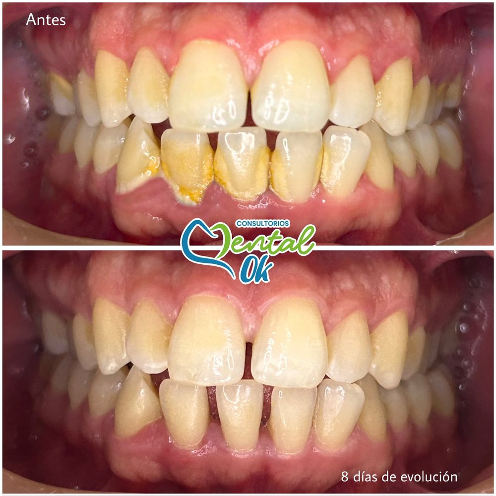 Antes y después de una limpieza dental: sarro en los dientes inferiores y encías a los 8 días