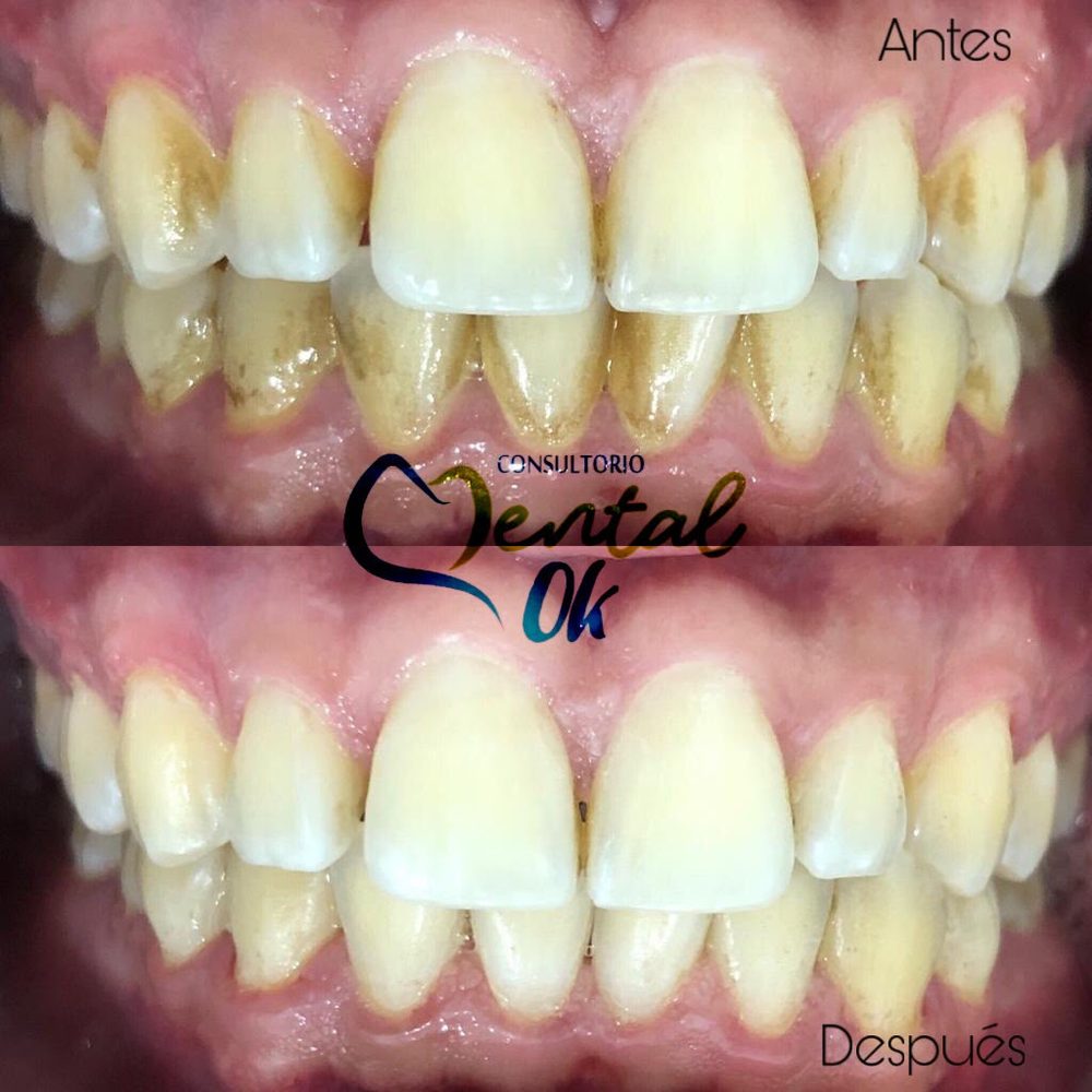 Antes y después de una limpieza dental: dientes con sarro y manchas, y luego limpios