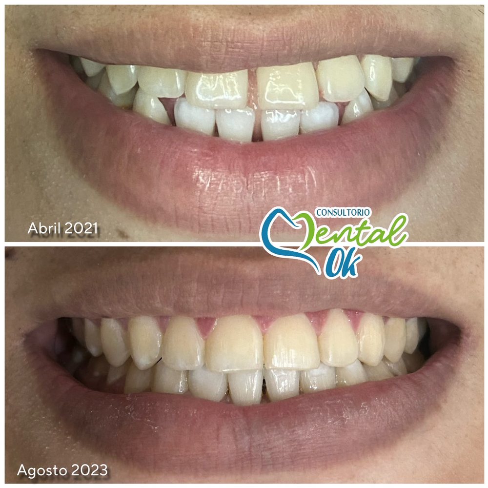 Sonrisa antes y después de la ortodoncia, de abril de 2021 a agosto de 2023, con cierre de espacios entre los dientes