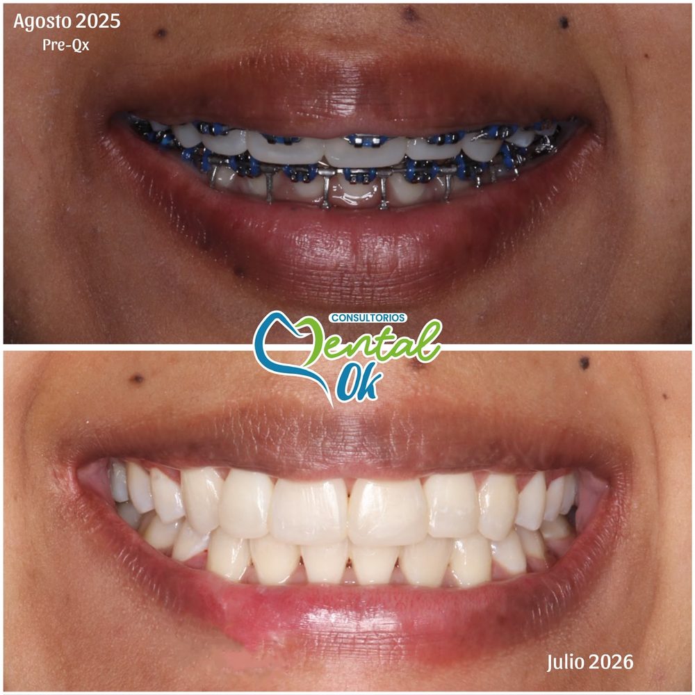Sonrisa con brackets en agosto de 2025 y sin brackets en julio de 2026, caso de ortodoncia en Dental OK
