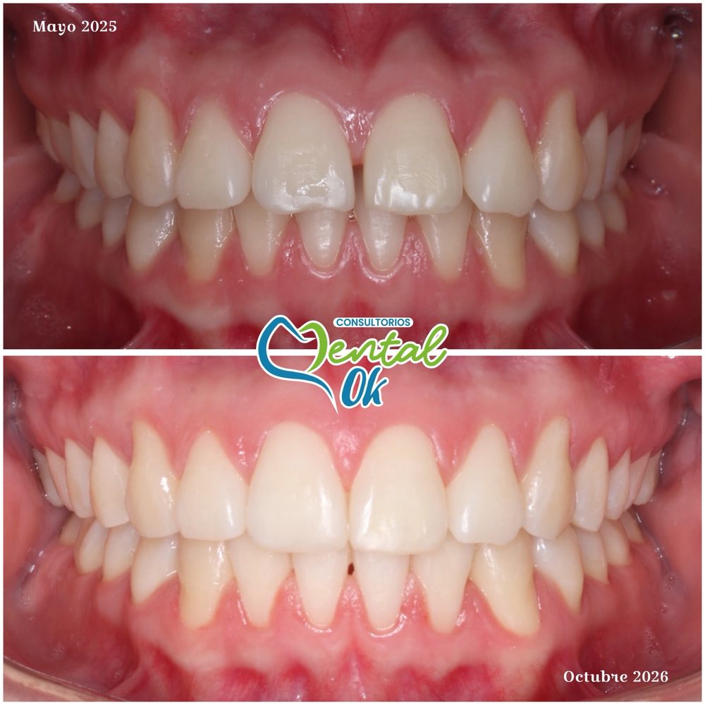 Vista frontal de los dientes antes y después de la ortodoncia, de mayo de 2025 a octubre de 2026