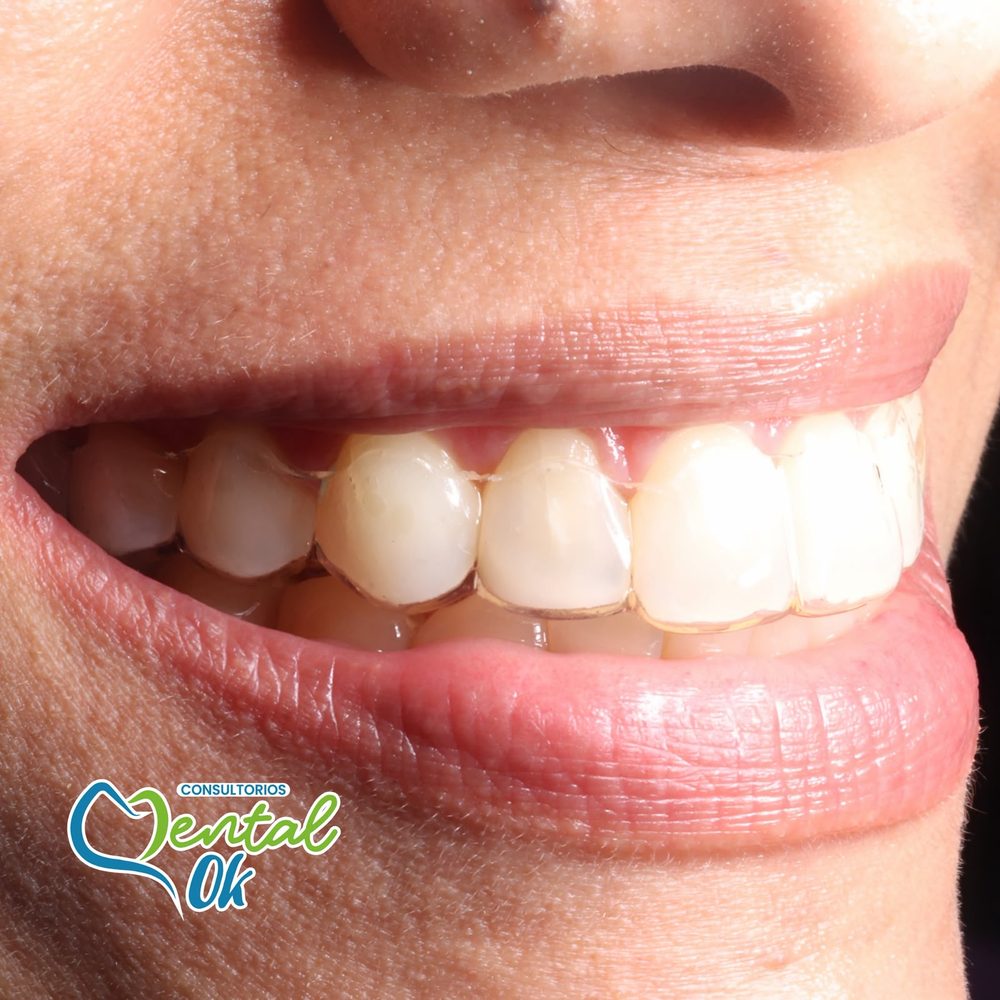 Paciente con retenedor de acetato transparente colocado en los dientes superiores