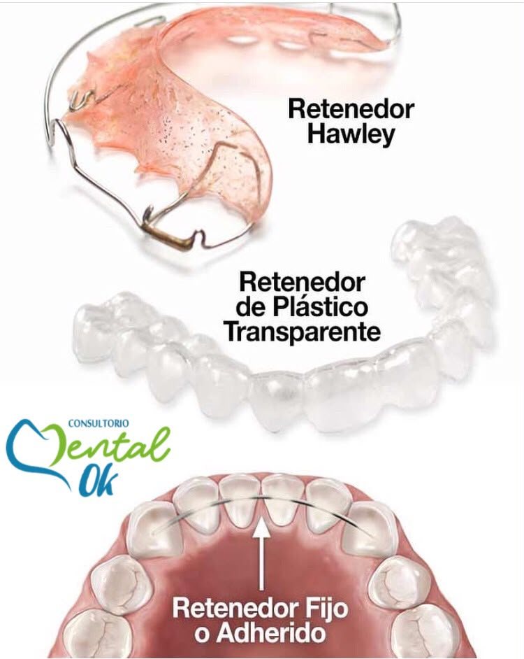 Ilustración de los tres tipos de retenedor: Hawley, de plástico transparente y fijo o adherido