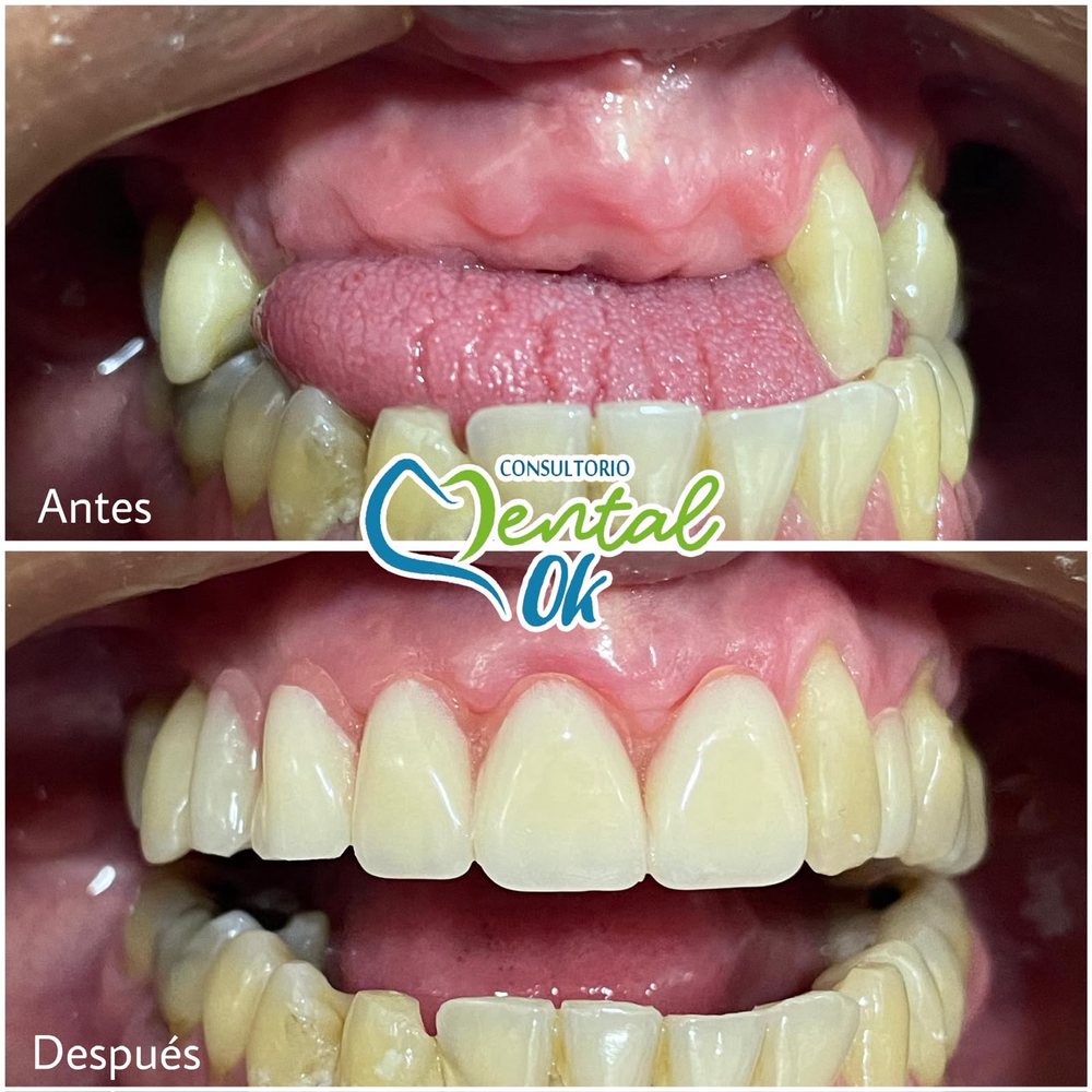 Antes y después de una prótesis que reemplaza los dientes delanteros superiores faltantes, con la boca abierta