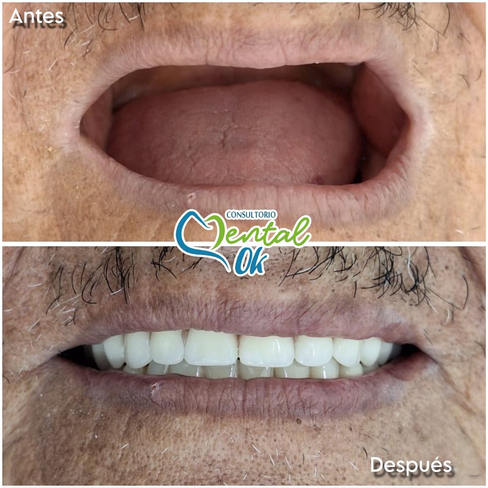 Antes y después de prótesis totales en un paciente adulto, vista de la sonrisa