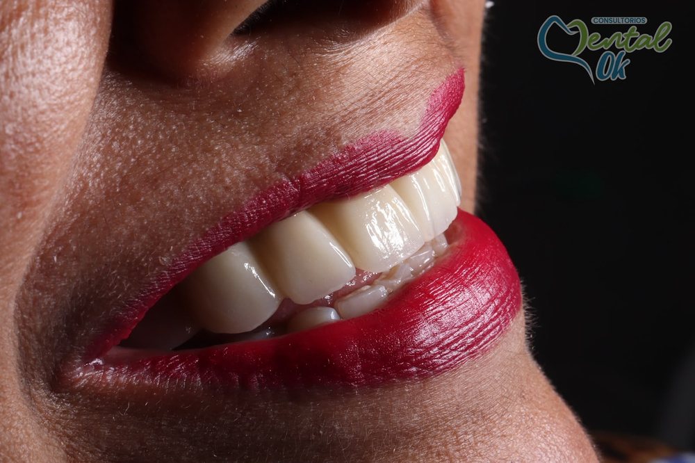Sonrisa de perfil de una paciente con puente fijo de zirconia en los dientes superiores