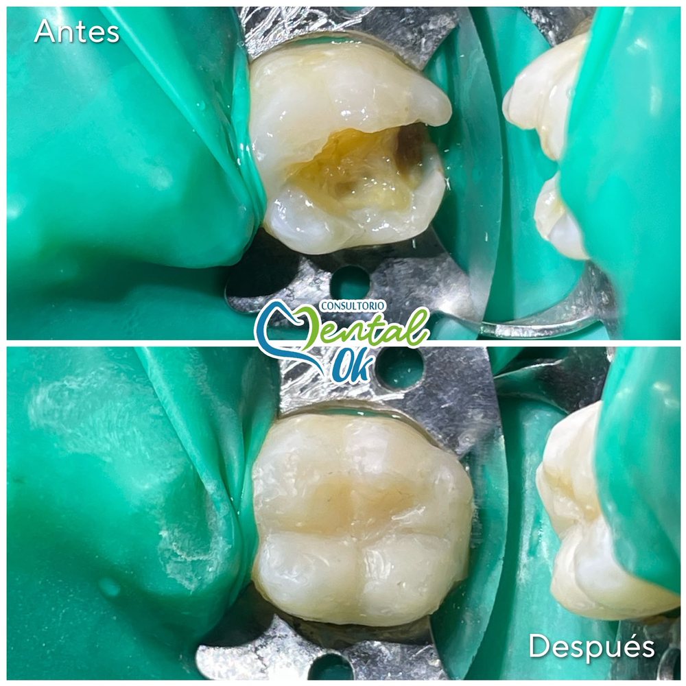 Antes y después de la restauración con resina de una muela con caries, con aislamiento para trabajar en seco