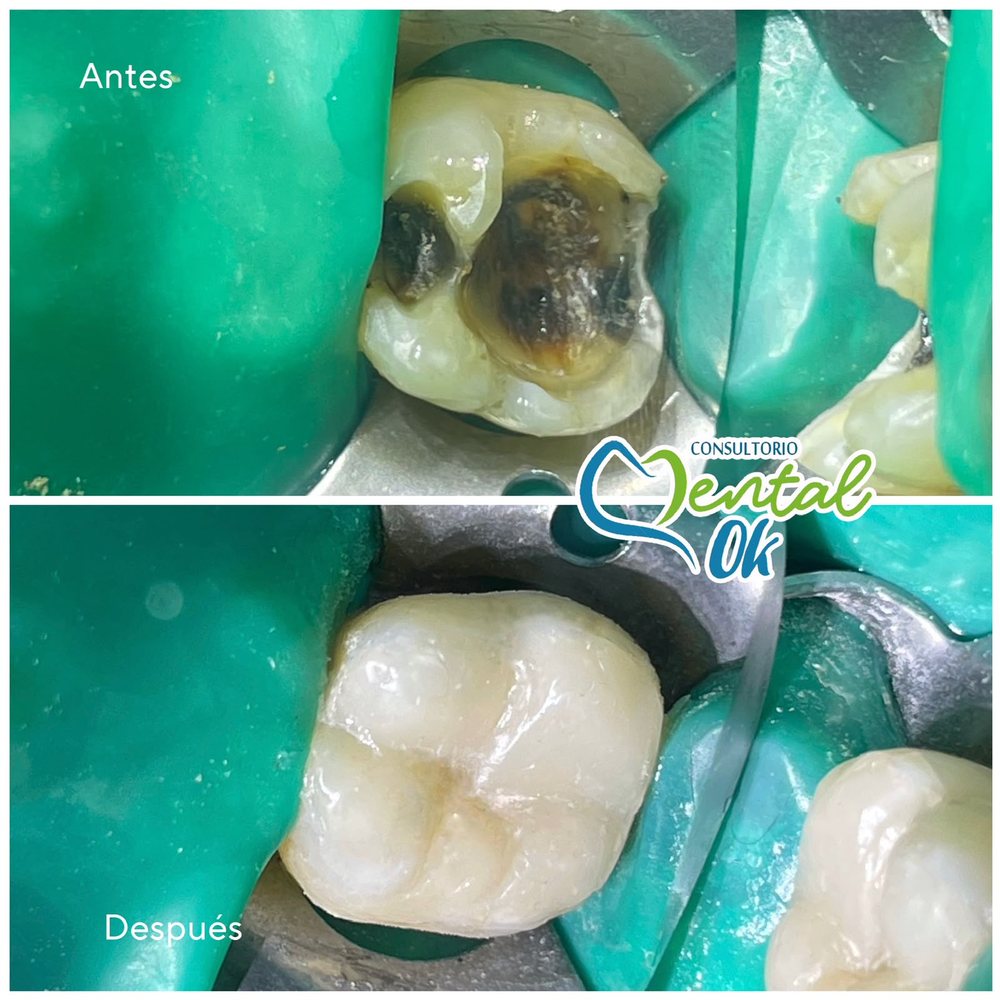 Antes y después de la restauración con resina de una muela con caries oscura, con aislamiento para trabajar en seco
