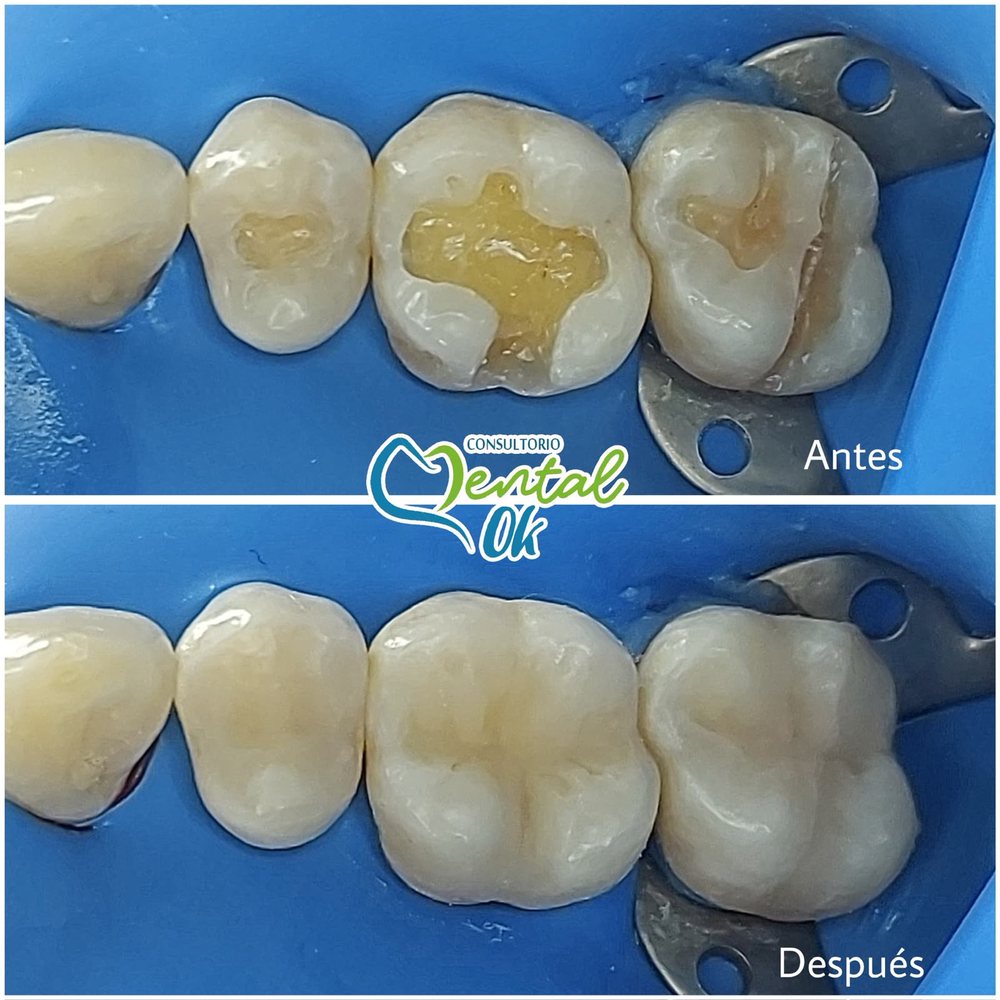 Antes y después de la restauración con resina de tres muelas con caries